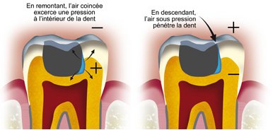 barotraumatisme-dentaire1 (1)